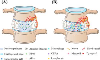 The JNK signaling pathway in intervertebral disc degeneration